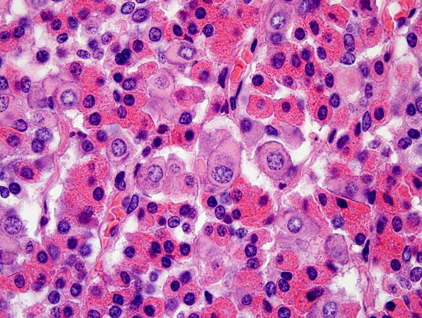 4A4 Empty Sella Syndrome (Case 4) Crooke's change H&E 100X 9