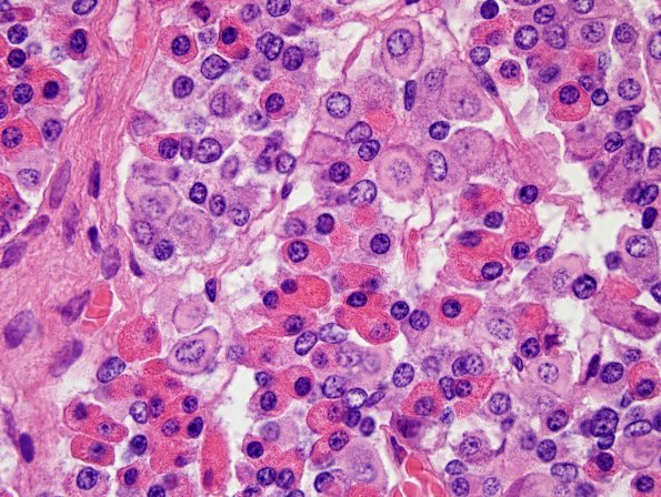 4A5 Empty Sella Syndrome (Case 4) Crooke's change H&E 100X 7