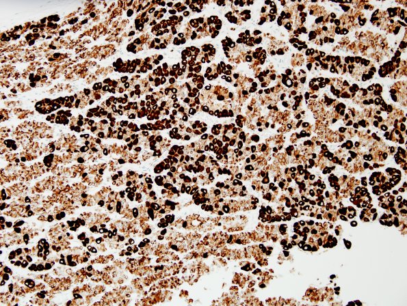 4A6 Empty Sella Syndrome (Case 4) Crooke's change PanCK 5