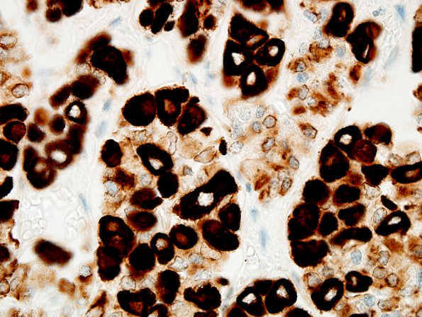 4A7 Empty Sella Syndrome (Case 4) Crooke's change 100X PanCK 2