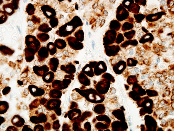 4A8 Empty Sella Syndrome (Case 4) Crooke's change 100X PanCK 3