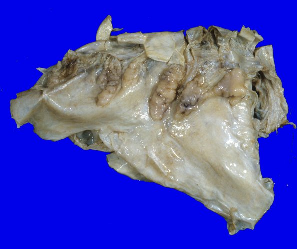 10 Dura, ossification (Case 12)A