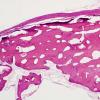 1A2 Bone formation, dura (Case 1) H&E 1