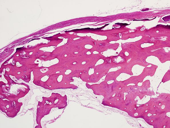 1A2 Bone formation, dura (Case 1) H&E 1