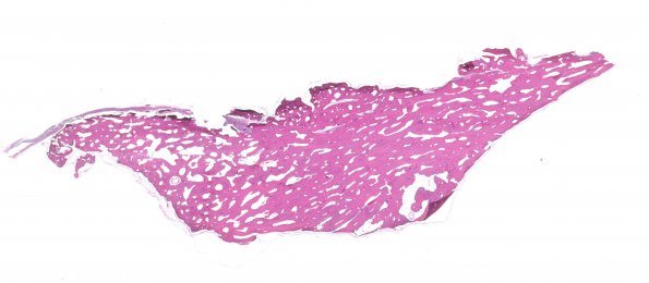 1A3 Bone formation, dura (Case 1) H&E whole mount