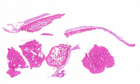 2A2 Bone formation, dura (Case 2) H&E 1A