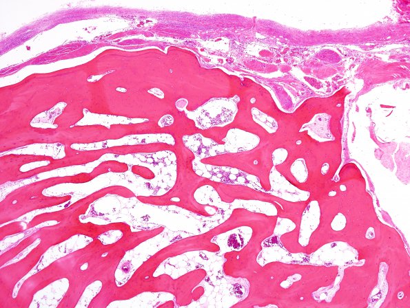 2A3 Bone formation, dura (Case 2) H&E 2.