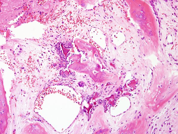 4 Bone formation, post-surgical (Case 5) H&E