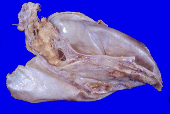 8 Dura, ossification (Case 10)A