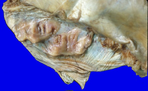 9 Dura, ossification (Case 11)A