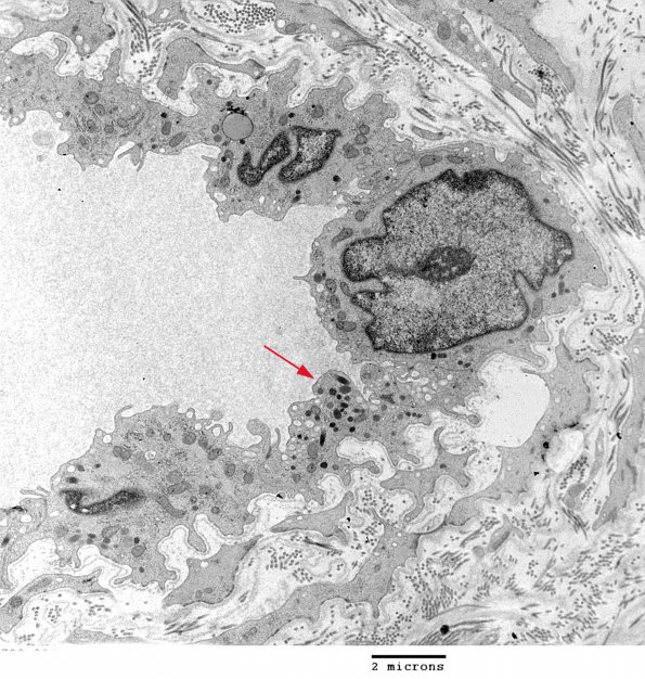 1A1 Endothelium, Weibel-Palade Bodies (Case 1) Skin EM 026