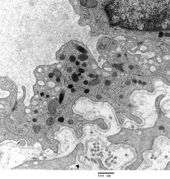 1A2 Endothelium, Weibel-Palade Bodies (Case 1) Skin EM 027