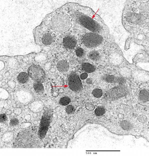 1A3 Endothelium, Weibel-Palade Bodies (Case 1) Skin EM 029