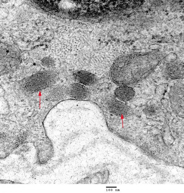 1A4 Endothelium, Weibel-Palade Bodies (Case 1) Skin EM 030