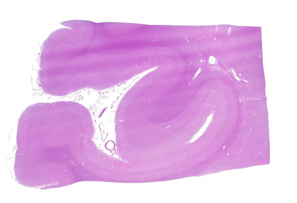 11A1 Occipital Seam, AD & DLBD (Case 18) H&E WM