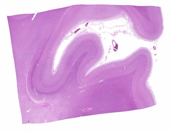 12A1 Occipital ventricular seam (Case 19) H&E 4