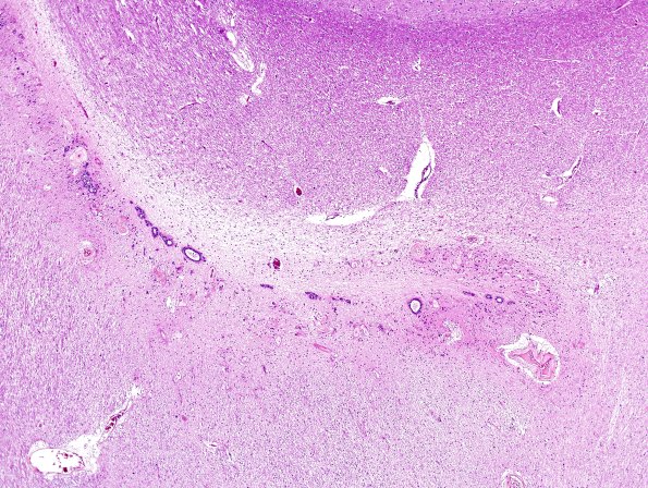 12A2 Occipital ventricular seam (Case 19) H&E 3