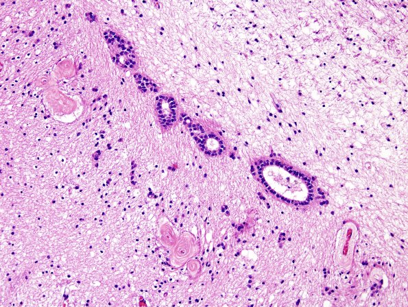 12A3 Occipital ventricular seam (Case 19) H&E 2