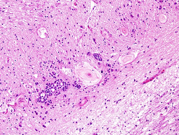 12A4 Occipital ventricular seam (Case 19) H&E 1