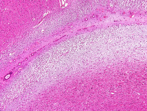 13A2-Periventricular-Seam-Case-20-N5-occipital-H-E-2A.jpg