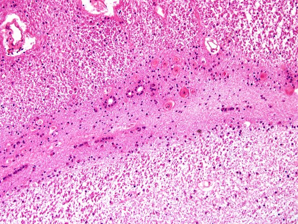 13A3-Periventricular-Seam-Case-20-N5-occipital-H-E-3.jpg