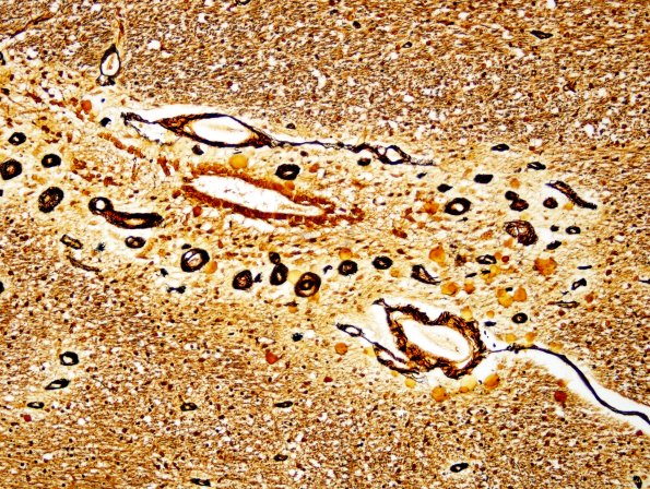14B Seam-Dementia-multi-infarct-Case-21-N5-Biels-1.jpg