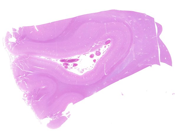 15A1 Occipital Seam (Case 22) H&E WM