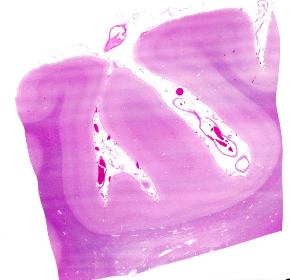 16A1 Periventricular Seam, occipital lobe (Case 23) H&E WM