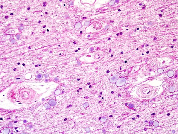 16A5-Periventricular-Seam-occipital-lobe-Case-23-H-E-7.jpg