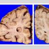 18A1 Comparison Ependymal Seam Cyst vs Control