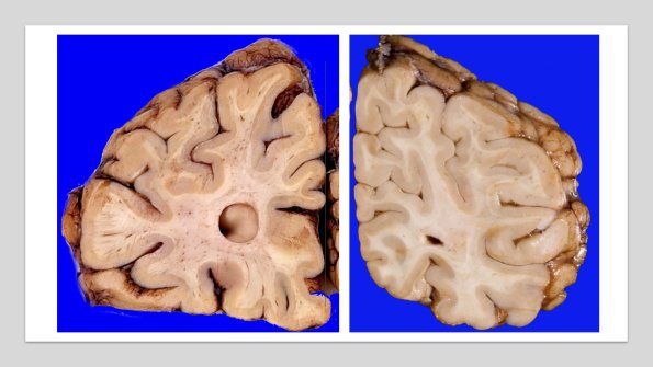 18A1 Comparison Ependymal Seam Cyst vs Control
