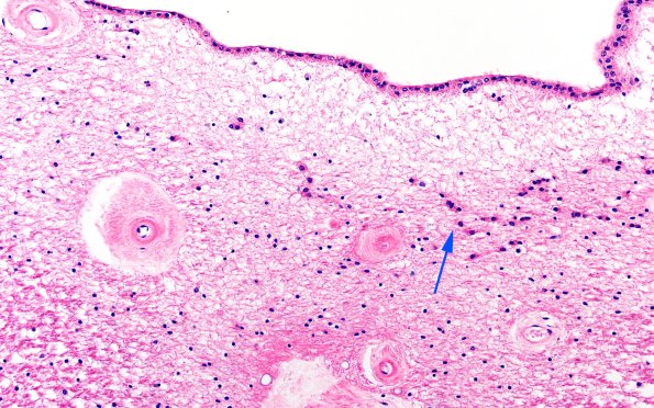 18B3C (Case 18) N12 H&E 20X copy
