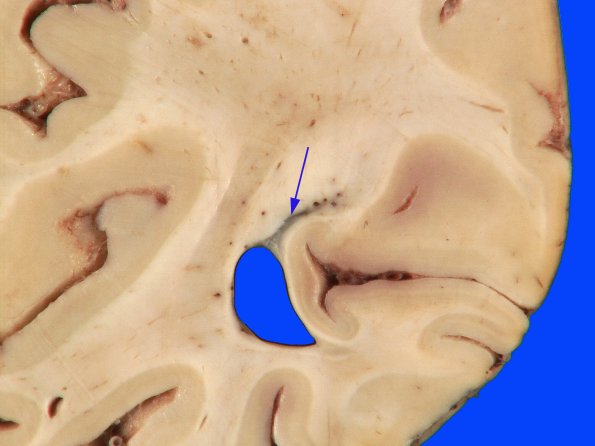 18C Ependymal Fusion Seam, occipital lobe (Case 1) 3