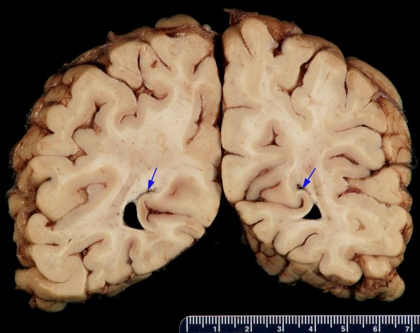 1A1 Ependymal Fusion Seam, occipital lobe (Case 1) 1