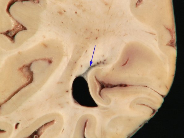 1A2 Ependymal Fusion Seam, occipital lobe (Case 1) 3