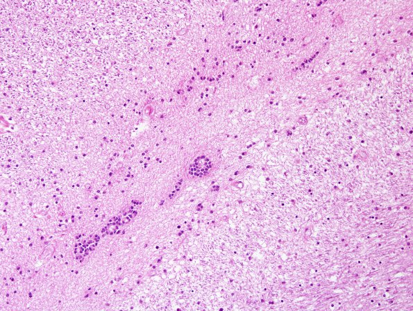 2A1 Ependymal Fusion Seam, occipital lobe (Case 2) H&E 4