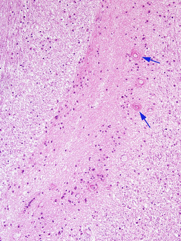 2A2 Ependymal Fusion Seam, occipital lobe (Case 2) H&E 3