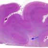 2A3 Ependymal Fusion Seam, occipital lobe (Case 2) H&E 1