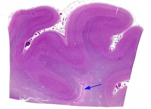 2A3 Ependymal Fusion Seam, occipital lobe (Case 2) H&E 1