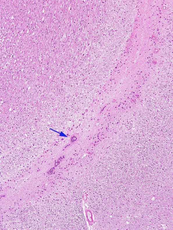 2A4 Ependymal Fusion Seam, occipital lobe (Case 2) H&E 2