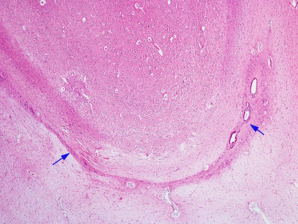 3A1 Ependymal Fusion Seam, occipital lobe (Case 3) H&E 1