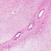 3A2 Ependymal Fusion Seam, occipital lobe (Case 3) H&E 2