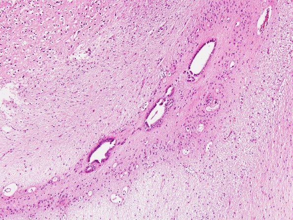 3A2 Ependymal Fusion Seam, occipital lobe (Case 3) H&E 2