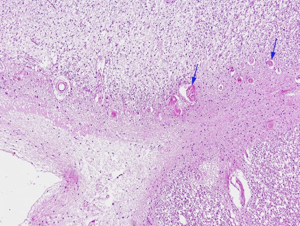 4A2 Ependymal Fusion Seam, occipital lobe (Case 6) H&E 2