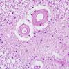 4A4 Ependymal Fusion Seam, occipital lobe (Case 6) H&E 4