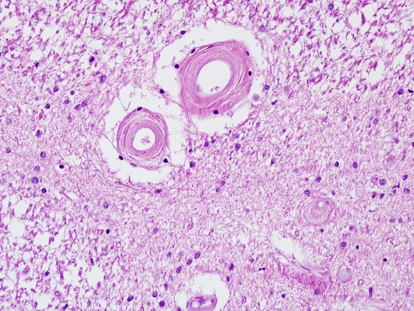 4A4 Ependymal Fusion Seam, occipital lobe (Case 6) H&E 4