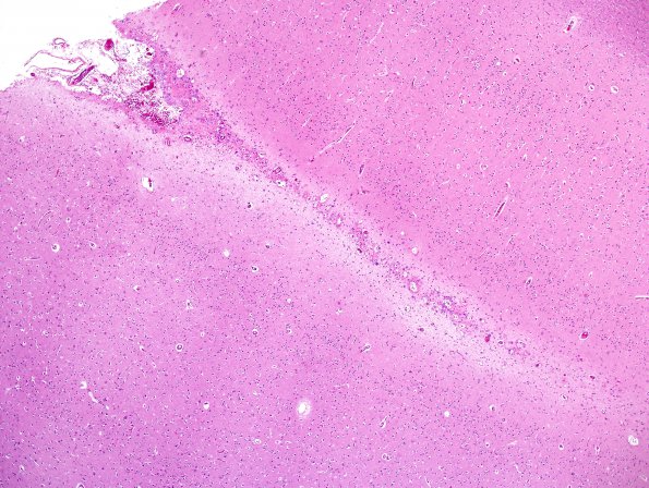 5A1 Ependymal Fusion Seam vs Sulcus, tangential cut (Case 8) H&E 1