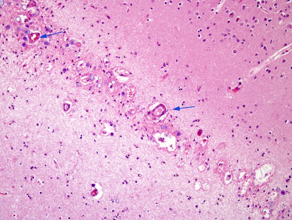 5A2 Sulcus, tangential cut (Case 8) H&E 2