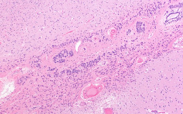 7A2 Basal Ganglia Ependymal Seam (Case 9) N2 H&E 4