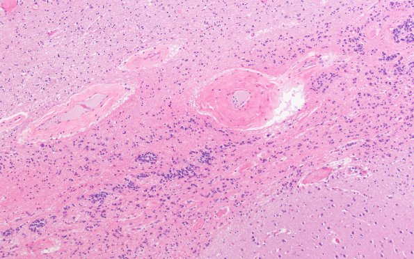 7A3 Basal Ganglia Ependymal Seam (Case 9) N2 H&E 3